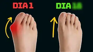 BUNION: How to fix it at home WITHOUT surgery