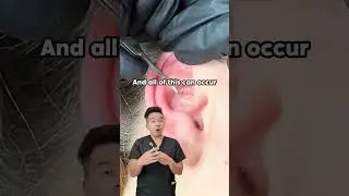 Blackheads and whiteheads in the ear❓