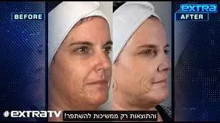 טיפול הפנים  שהקרדשיאן לא יכולות בלעדיו