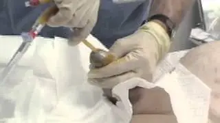 Male Urethral Catheterization NEJM
