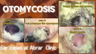 Otomycosis | fungal ear infection | otitis externa
