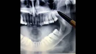 How to diagnose Tempromandibular joint dislocation?