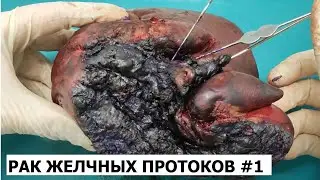Рак внепеченочных желчных протоков #1 (опухоль Клатскина)