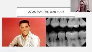 How to Identify Composite Restorations on Radiographs