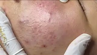 Acne treatment for Tham (P2) 
