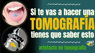 ARTEFACTO EN TOMOGRAFIA