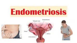 Endometriosis | Causes, Pathophysiology, Symptoms, Diagnosis & Treatment