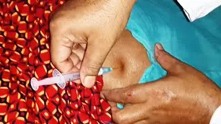 ivf buttock injection video.Triamcinolone Intramuscular buttock injection push 24 Ep 104 Anik Health