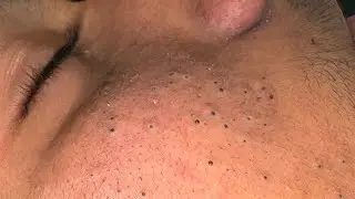 [ASMR] Blackhead and Whitehead Removal Facial Therapy