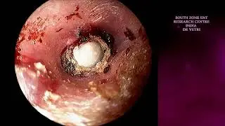 EPITHELIEAL PEARL