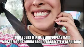 FIZ GENGIVOPLASTIA PELO PLANO ODONTOLOGICO!!! (MOSTREI TODA MINHA RECUPERAÇÃO)