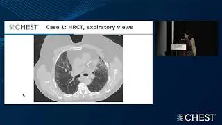 Mock Multidisciplinary Discussion in Interstitial Lung Diseases - To Biopsy or Not