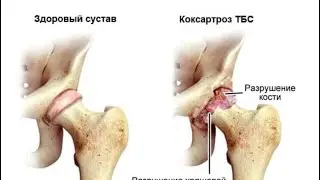 Здоровые суставы 💯