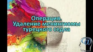 Операция. Удаление менингиомы турецкого седла. Нейрохирургия