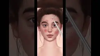 Asmr pimples pop 
