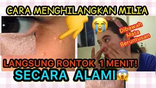 🛑LANGSUNG RONTOK SEKETIKA CARA MENGHILANGKAN MILIA PADA WAJAH SECARA ALAMI TERCEPAT AMPUH | nadiSSE