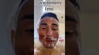7 Meses depois do procedimento de Fenol Profundo para tratar cicatrizes de acne.