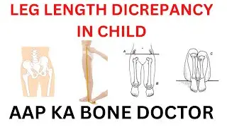 LEG LENGTH DISCREPANCY IN CHILDREN - EPISODE 58