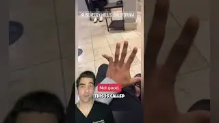 Finger Dislocation