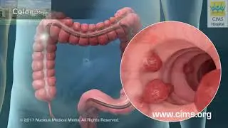 Colorectal Cancer (Hindi) – CIMS Hospital