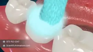 Dental Sealants - Tooth Decay Treatment