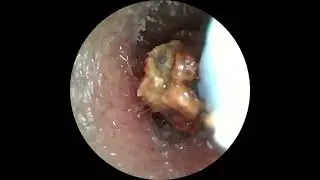 Insane Ear Wax Removal with Camera Tool!