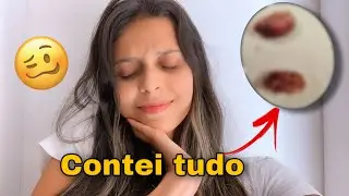 MINHA PRIMEIRA SEMANA PÓS CIRURGIA DAS AMÍGDALAS