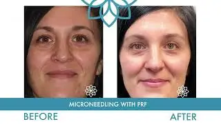 Microneedling with PRF by CARE Esthetics