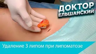 Удаление липом бедра при липоматозе