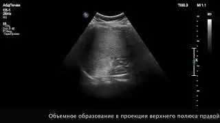 Забрюшинное объемное образование в проекции верхнего полюса правой почки