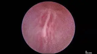 Core Videos (2021): Posterior Urethral Valve Ablation