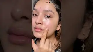 How To Get Rid Of Acne On Cheeks | Causes And Treatment For Acne | Be Beautiful 