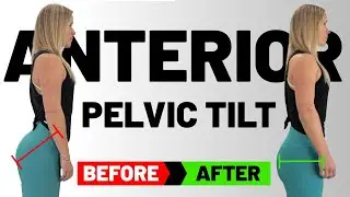 3 Yoga Exercises to FIX Anterior Pelvic Tilt | Goodbye BACK Pain