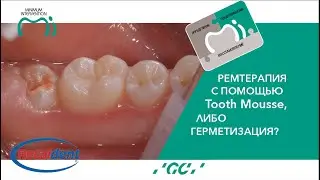 Ремтерапия или герметизация? #toothmousse #гигиеназубов #тусмусс