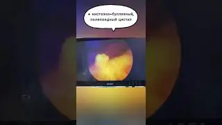 ⚕️На видео представлена  цистоскопия молодого человека, страдающего затрудненным мочеиспусканием.