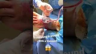 How wounds are healed!😱 