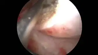endoresekce polyp 3cm