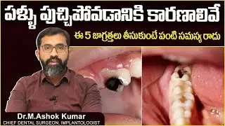 పళ్ళు పుచ్చడానికి కారణం | Causes of Tooth Cavity in Telugu | Tooth Decay | Eledent Dental Hospitals