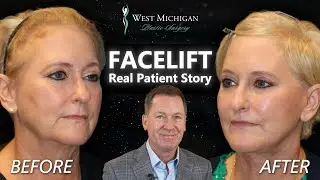 Facelift - Age 60-70 - Beautiful & Natural Results - Real Patient Story!