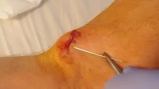 How To Give Yourself Stitches (Sutures)