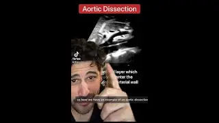 Aortic Dissection
