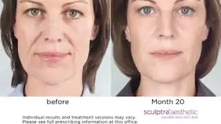 Sculptra  Facial Injectable for Anti Aging @ Enhanze Clinic