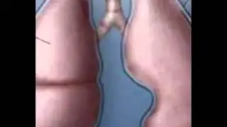 mesothelioma