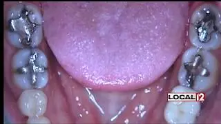 Duane, Is That Right? Dark fillings in your teeth dangerous?