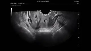 Nice spot case uterine anomaly didylphis uterus (mindray newea i9 )