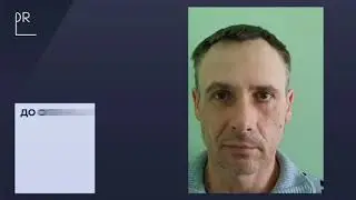 Травма лицевого нерва
