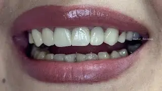 Винир | veneer 👉tel/WhatsApp +992934090800