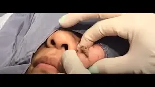 Pimple Popping & Cystic Acne Removal | Big Pimple Popper!