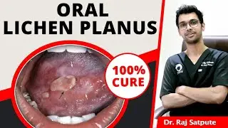Oral Lichen Planus 100% Cure | How to Cure Lichen Planus Naturally & Permanently At Home | JYOVIS