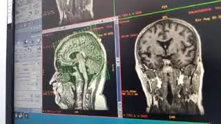 Mri reconstruction ge 15x